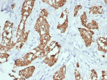 IHC staining of FFPE human breast cancer with TrkC antibody (clone NTRK3/7140). HIER: boil tissue se