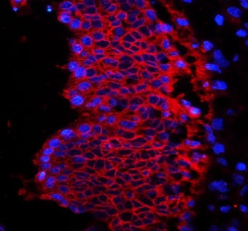 Immunofluorescent staining of human rectal cancer tissue with EpCAM antibody (red) and DAPI (blue). 