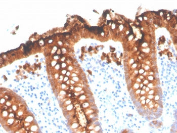 IHC staining of FFPE human colon with recombinant CEA antibody (clone C66/3707R). HIER: boil tissue 