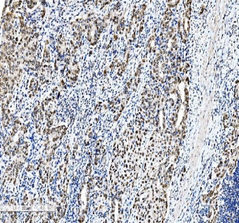 IHC staining of FFPE human squamous metaplasia of renal pelvis tissue with C/EBP beta antibody. HIER