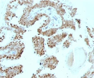 IHC: Formalin-fixed, paraffin-embedded human prostate carcinoma stained with p57Kip2 antibody (SPM30