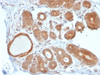IHC staining of FFPE human breast carcinoma with STAT5b antibody. HIER: boil tissue sections in pH 9