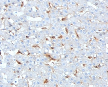 IHC staining of FFPE human hepatocellular carcinoma tissue with Complement C1q B-Chain antibody (clo