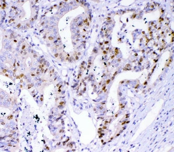 IHC staining of FFPE human colon cancer tissue with Survivin antibody. HIER: boil tissue sections in
