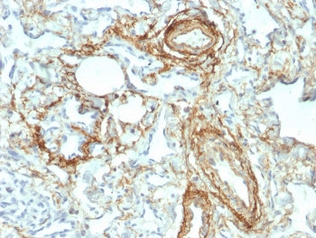 IHC staining of FFPE human angiosarcoma with Elastin antibody (clone ELN/2069). HIER: boil tissue se
