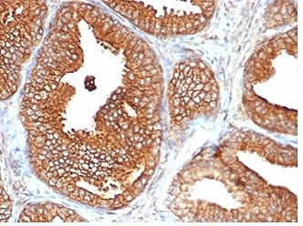 IHC staining of FFPE human prostate carcinoma tissue with recombinant CD47 antibody (clone CD47/6362