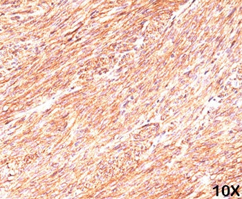 IHC testing of human gastrointestinal stromal tumor (GIST) and DOG1 antibody (clone tDAN4). Required
