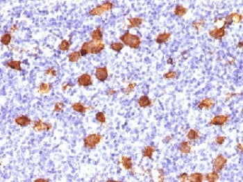 IHC testing of FFPE human Hodgkin's lymphoma stained with CD30 antibody. Required HIER: steam sectio