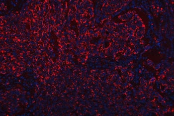 Immunofluorescent staining of FFPE human lung squamous cell carcinoma tissue with SR-BII antibody (r