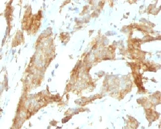 IHC analysis of formalin-fixed, paraffin-embedded human breast carcinoma stained with gp96 antibody 