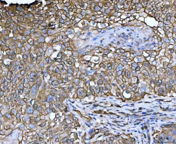 IHC staining of FFPE human lung squamous cell carcinoma tissue with LIMA1 antibody. HIER: boil tissu
