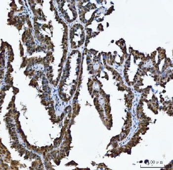 IHC staining of FFPE human ovarian cancer tissue with MRPP1 antibody. HIER: boil tissue sections in 