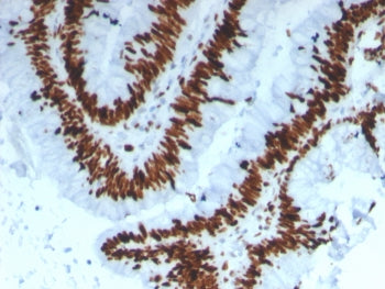 IHC staining of FFPE human colon carcinoma tissue with MCM3 antibody (clone MCM3/3221). HIER: boil t