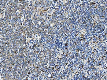 IHC staining of FFPE human B lymphocytic tumor tissue with ARHGAP45 antibody. HIER: boil tissue sect