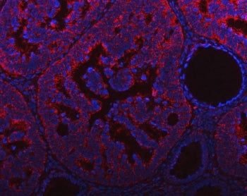 Immunofluorescent staining of FFPE human intestinal cancer tissue with HRPAP20 antibody (red) and DA