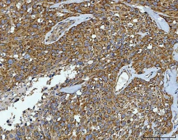 IHC staining of FFPE human squamous carcinoma tissue with CAD Protein antibody. HIER: boil tissue se