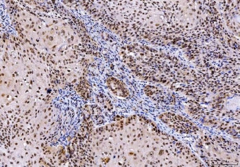 IHC staining of FFPE human laryngeal squamous cell carcinoma tissue with PTP1C antibody. HIER: boil 
