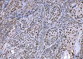 IHC staining of FFPE human laryngeal squamous cell carcinoma tissue with BRCA1 antibody. HIER: boil 