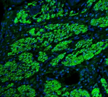 Immunofluorescent staining of FFPE human esophagus cancer tissue with TAGLN antibody (green) and DAP