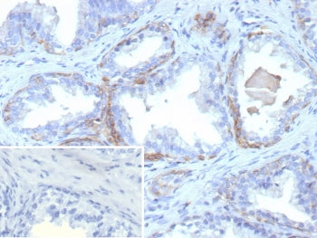 IHC staining of FFPE human prostate carcinoma tissue with recombinant KRT13 antibody (clone rKRT13/9