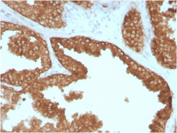 IHC staining of FFPE human prostate carcinoma with c-RET antibody. HIER: boil tissue sections in pH 