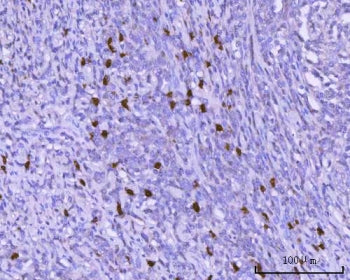 IHC staining of FFPE human lymphoma tissue with PAX5 antibody. HIER: boil tissue sections in pH8 EDT