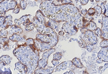 IHC staining of FFPE human hepatocellular carcinoma tissue with Glypican-3 antibody (clone GPC3/8127