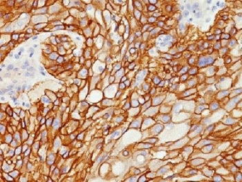 IHC testing of FFPE human lung squamous cell carcinoma with EGF Receptor antibody (clone GFR/1708). 