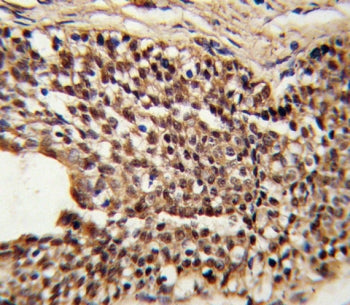 IHC testing of FFPE human prostate carcinoma tissue with TPI1 antibody. HIER: steam section in pH6 c
