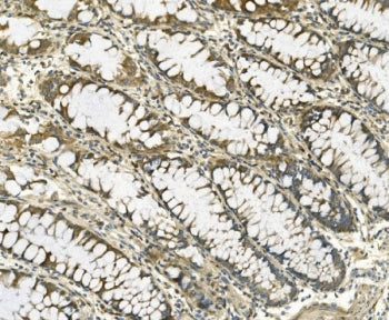 IHC staining of FFPE human rectal cancer with Galectin-2 antibody. HIER: boil tissue sections in pH8