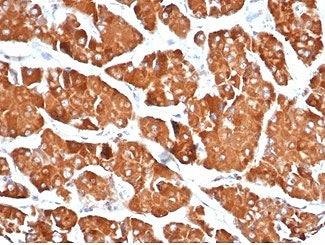 IHC staining of FFPE human renal oncocytoma with RHOBTB2 antibody (clone DBC2/3361) at 2ug/ml in PBS