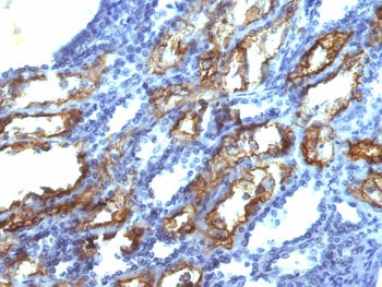 IHC testing of FFPE human renal cell carcinoma with IFN gamma antibody (clone IFNG/466). Required HI