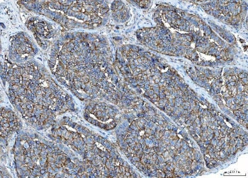 IHC staining of FFPE human liver cancer tissue with Poliovirus Receptor antibody. HIER: boil tissue 