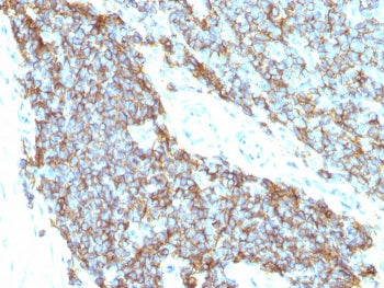 IHC staining of FFPE human Ewing's sarcoma with CD99 antibody (clones 12E7 + MIC2/877). Required HIE