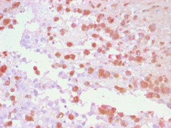 IHC staining of FFPE human melanoma tissue with Tyrosinase-Related Protein-1 antibody using AEC Chro