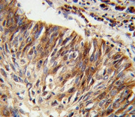 IHC testing of FFPE human lung carcinoma tissue with Aldehyde dehydrogenase family 3 member B1 antib