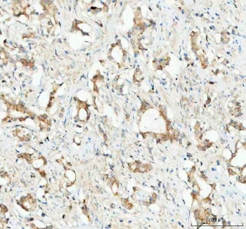 IHC staining of FFPE human prostatic acinar adenocarcinoma tissue with Glutathione Peroxidase 1 anti