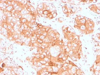 IHC staining of FFPE human testicular carcinoma with recombinant Prolactin Receptor antibody (clone 
