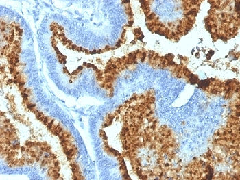 IHC: Formalin-fixed, paraffin-embedded human colon carcinoma stained with Blood Group B antibody (HE