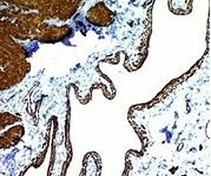 IHC: Formalin-fixed, paraffin-embedded human colon carcinoma stained with alpha Smooth Muscle Actin 