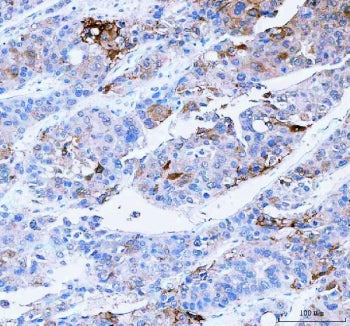 IHC staining of FFPE human liver cancer tissue with SCD1 antibody. HIER: boil tissue sections in pH8