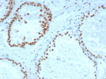 IHC staining of FFPE human prostate carcinoma tissue with Androgen Receptor antibody (clone DHTR/492