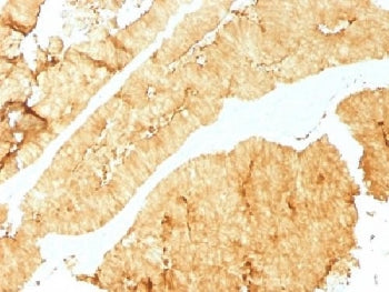 IHC testing of FFPE human colon with Villin antibody (clone VIL1/1325). Required HIER: boil tissue s