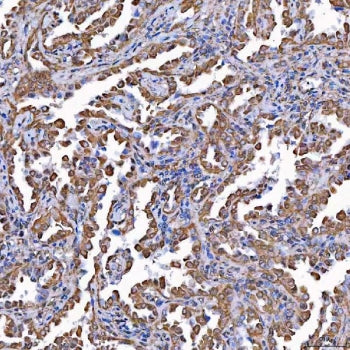 IHC staining of FFPE human lung cancer tissue with TOMM34 antibody. HIER: boil tissue sections in pH