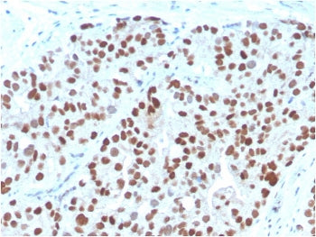 IHC staining of FFPE human prostate carcinoma with NKX3.1 antibody. HIER: boil tissue sections in pH