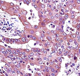 JAK2 antibody immunohistochemistry analysis in formalin fixed and paraffin embedded human lung adeno