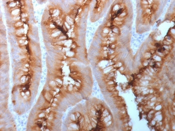IHC testing of FFPE human melanoma with CEA antibody (clone C66/1983R). Required HIER: boil tissue s