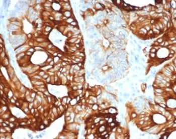 IHC staining of FFPE human colon carcinoma tissue with recombinant KRT20 antibody (clone KRT20/4380R