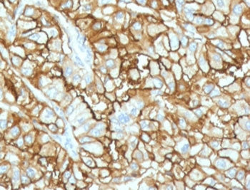 IHC testing of FFPE human renal cell carcinoma with recombinant CD34 antibody (clone CDLA34-2R). Req