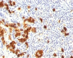 IHC: Formalin-fixed, paraffin-embedded human Hodgkin's lymphoma stained with SSEA-1 antibody (FUT4/8